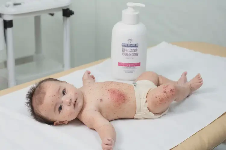 寶寶身上起濕疹可不可以徹底自愈(圖2)