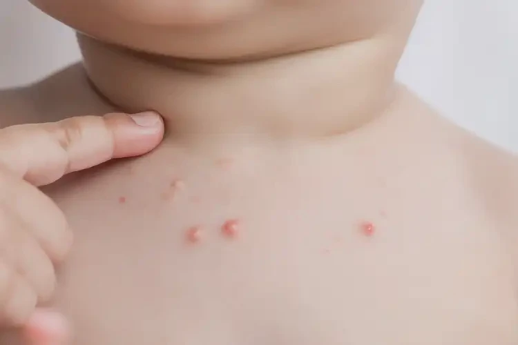 幼兒脖子上出現(xiàn)濕疹可不可以徹底自愈(圖4)