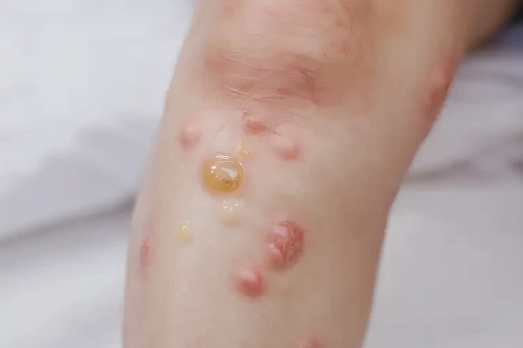 兒童大腿偶爾長濕疹不管它會(huì)自己痊愈嗎(圖2)