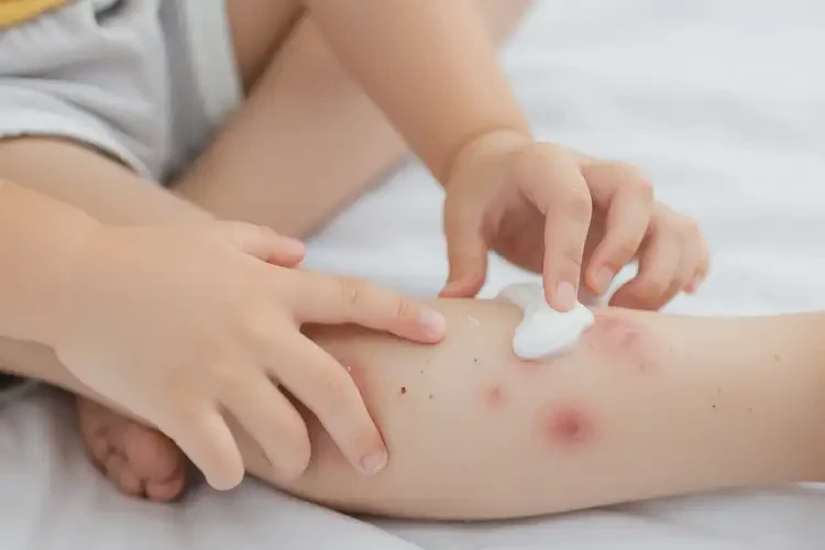 小孩小腿上偶爾起濕疹能靠自己自愈嗎(圖3)