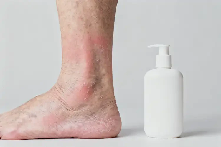 老人小腿上长湿疹可以彻底自愈吗(图3)