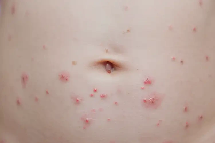 新生兒肚子容易長(zhǎng)濕疹不管它會(huì)自己自愈嗎(圖4)