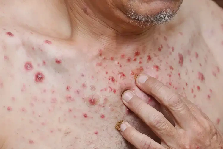 男人全身長濕疹可不可以徹底自愈(圖4)