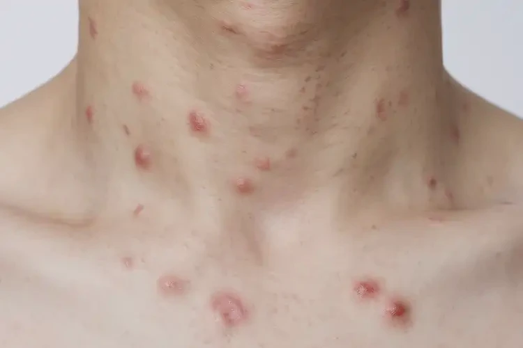 男生脖子上偶爾起濕疹可以徹底自愈嗎(圖4)