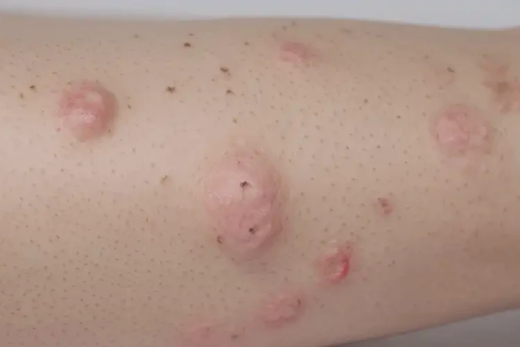 小兒大腿上長濕疹能靠自己自愈嗎(圖4)