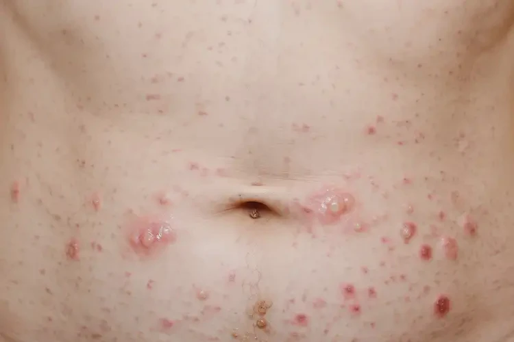 女人肚子上出現(xiàn)濕疹不管它會(huì)自己好嗎(圖4)