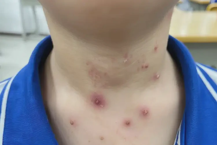 小學(xué)生脖子上長(zhǎng)濕疹不管它會(huì)自己自愈嗎(圖4)