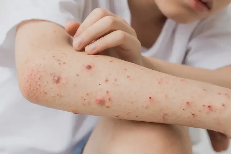 青少年四肢出现湿疹可不可以彻底自愈(图4)