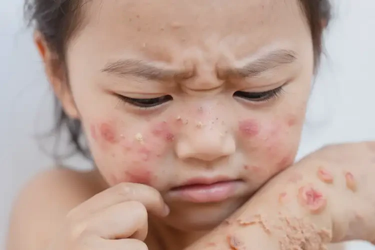 小孩身上長濕疹能靠自己自愈嗎(圖4)