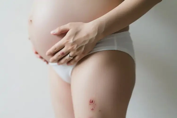 孕婦四肢長濕疹能徹底自愈嗎(圖1)