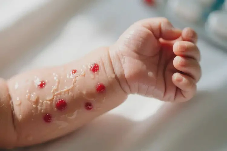 新生兒手臂上容易長(zhǎng)濕疹不管它會(huì)自己痊愈嗎(圖1)