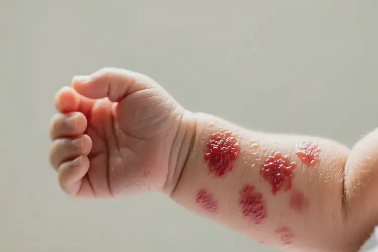 新生兒手臂上容易長(zhǎng)濕疹不管它會(huì)自己痊愈嗎(圖3)