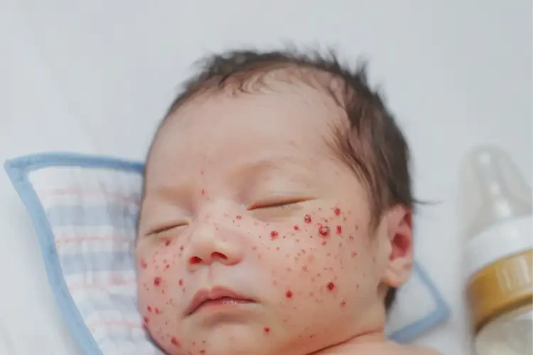 新生兒臉上容易長濕疹能夠徹底治愈嗎(圖4)
