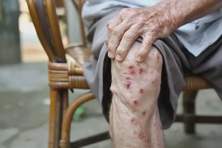 高齡老人小腿起濕疹不管它會自己自愈嗎(圖4)