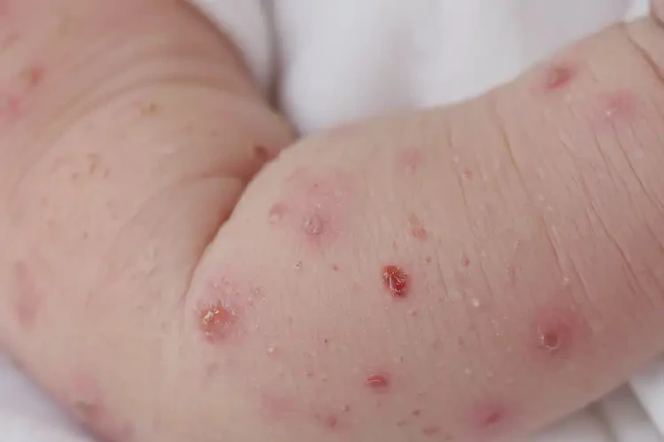 新生兒手臂上長(zhǎng)濕疹能夠徹底治愈嗎(圖4)