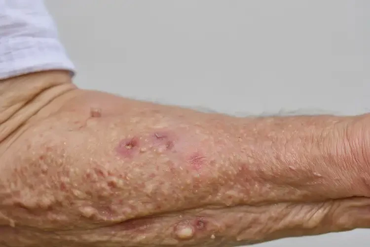 老年人手臂有濕疹能徹底自愈嗎(圖4)