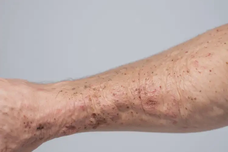 大學(xué)生脖子上有濕疹不管它會(huì)自己好嗎(圖3)