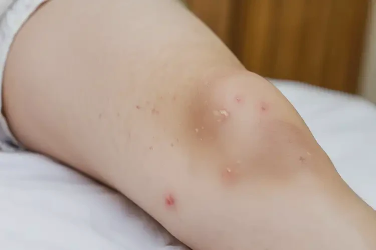 孩子大腿上偶爾起濕疹不管它會自己自愈嗎(圖4)