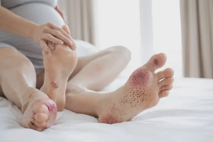 孕婦腳上容易長濕疹不管它會自己自愈嗎(圖4)