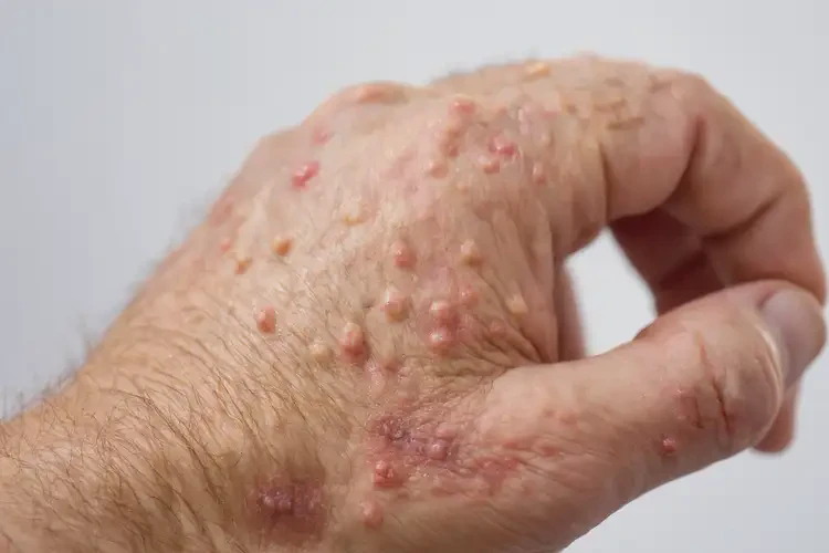 男性手上起濕疹不管它會(huì)自己自愈嗎(圖4)