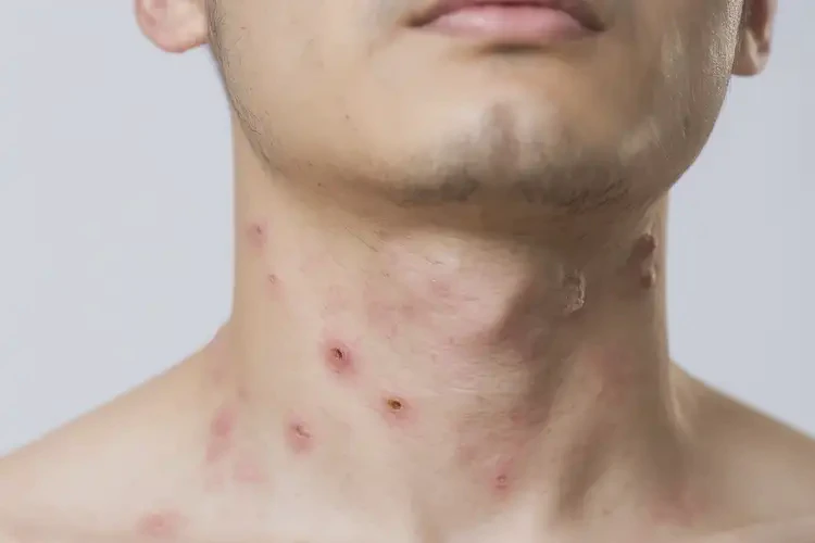 男生脖子上偶爾長(zhǎng)濕疹可以徹底自愈嗎(圖4)