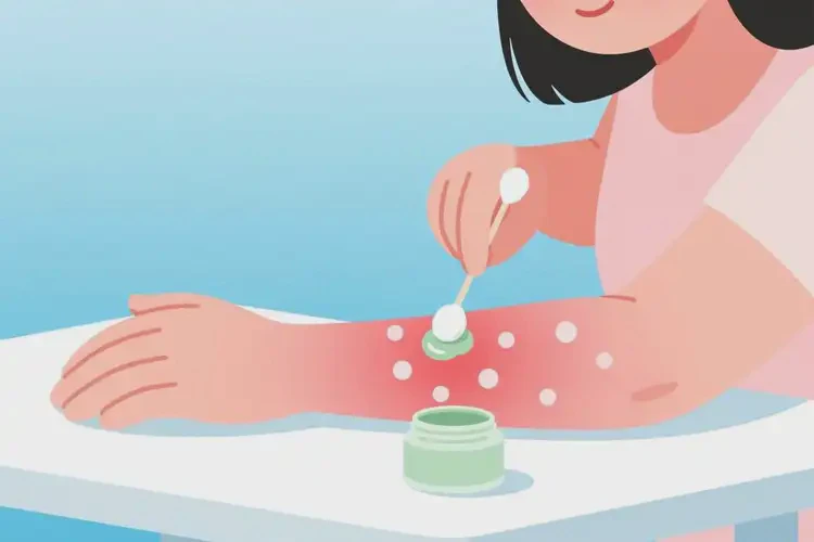 女生手臂上出濕疹能靠自己自愈嗎(圖3)