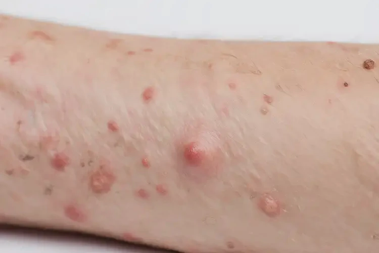 青少年手臂上起濕疹能夠徹底治愈嗎(圖4)