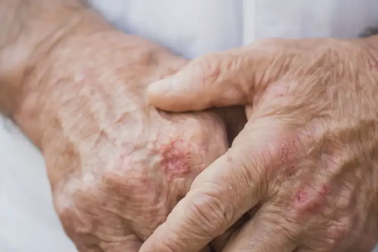 老年人手上偶爾長濕疹不管它會自己痊愈嗎(圖4)