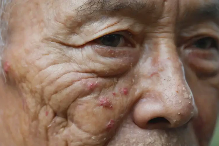 老年人屁股有濕疹可以徹底自愈嗎(圖4)