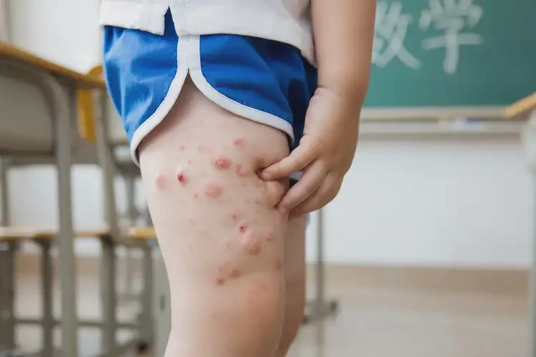 小學(xué)生小腿長濕疹不管它會自己自愈嗎(圖4)