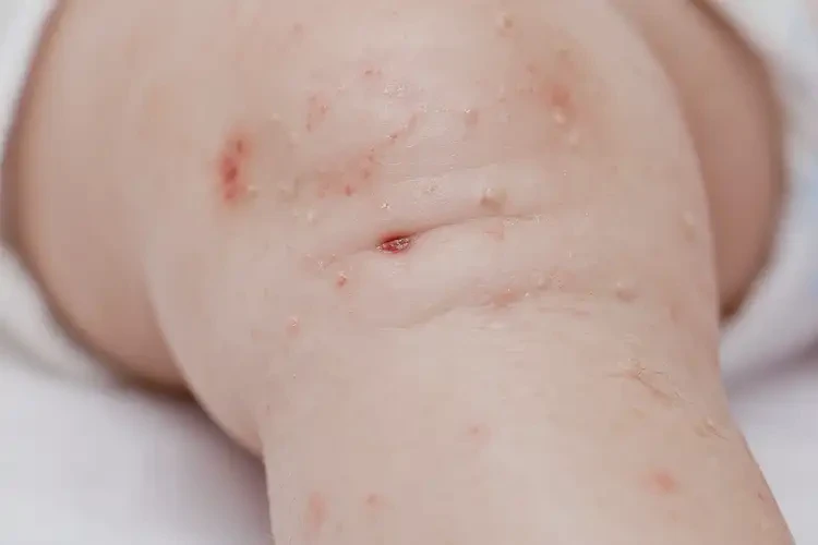 婴儿小腿上出现湿疹能够彻底治愈吗(图4)