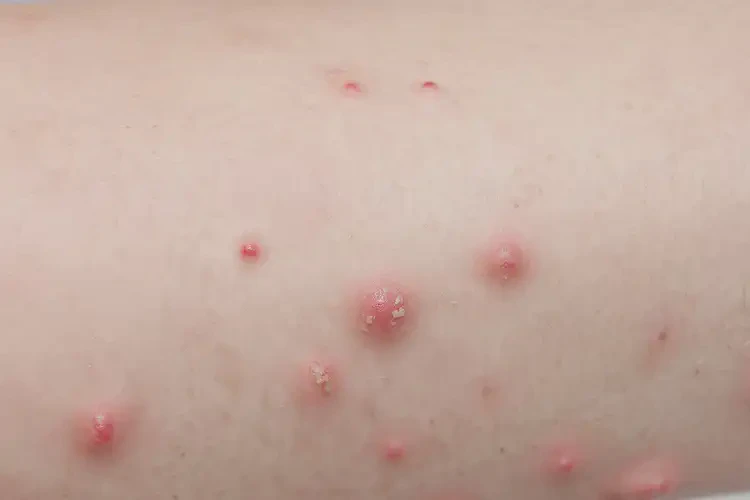 少兒屁股上有濕疹不管它會(huì)自己自愈嗎(圖4)