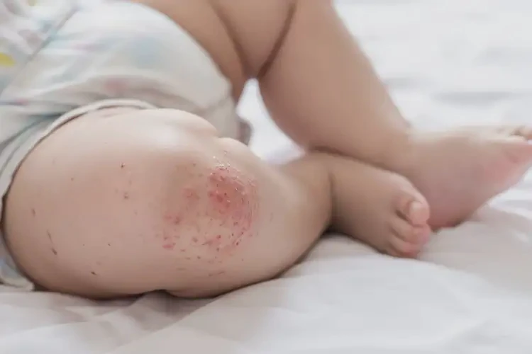 嬰兒大腿長濕疹能夠徹底治愈嗎(圖3)