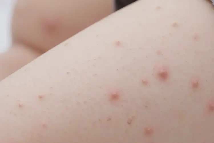 嬰幼兒大腿上經(jīng)常長(zhǎng)濕疹不管它會(huì)自己好嗎(圖4)