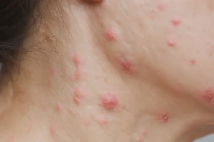 女生脖子起濕疹可以徹底自愈嗎(圖4)