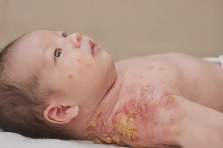 新生兒脖子上偶爾長濕疹不管它會自己自愈嗎(圖3)