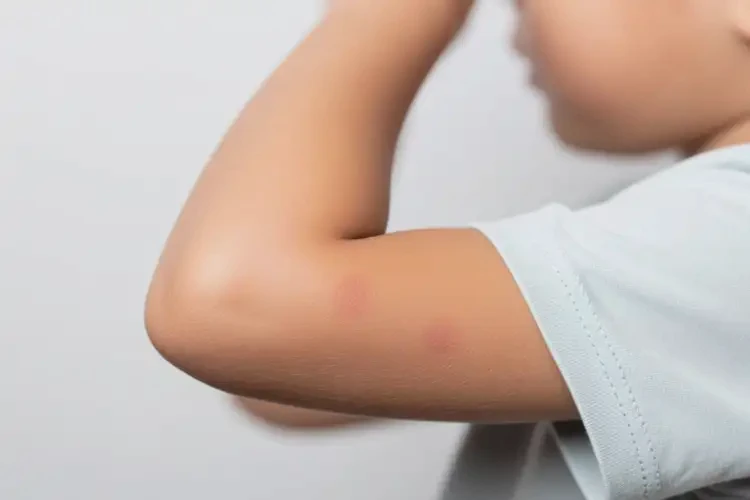 小孩手臂經(jīng)常長濕疹能徹底自愈嗎(圖1)
