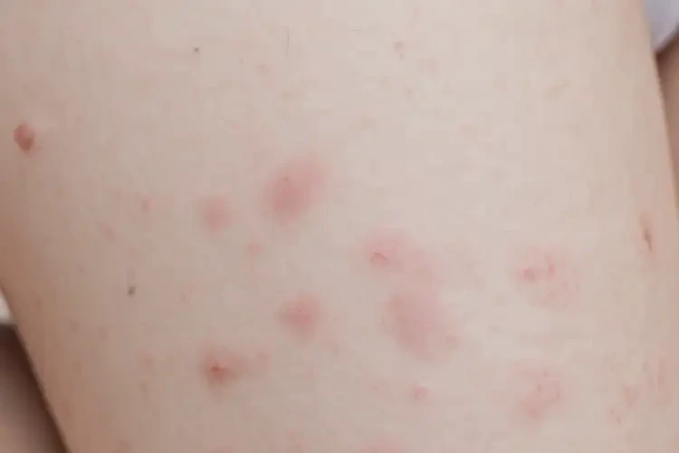 小儿大腿上偶尔起湿疹不管它会自己好吗(图4)