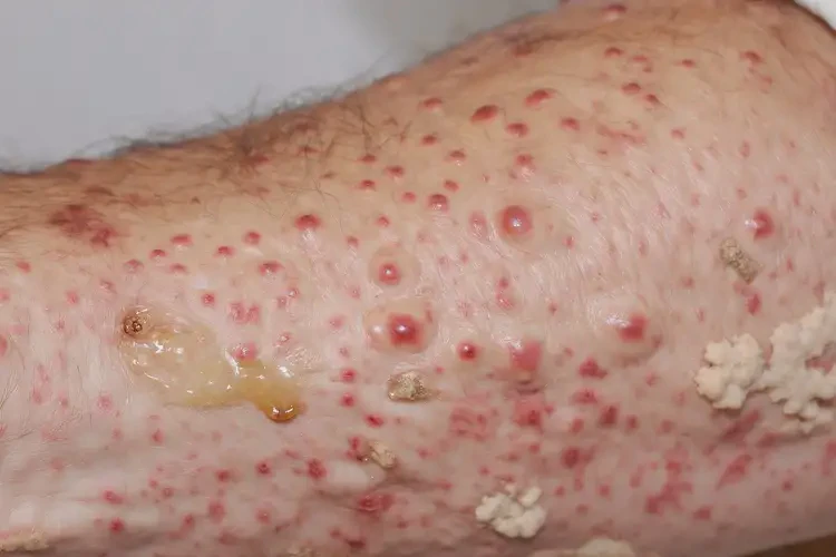 男生脖子上長(zhǎng)濕疹不管它會(huì)自己痊愈嗎(圖2)