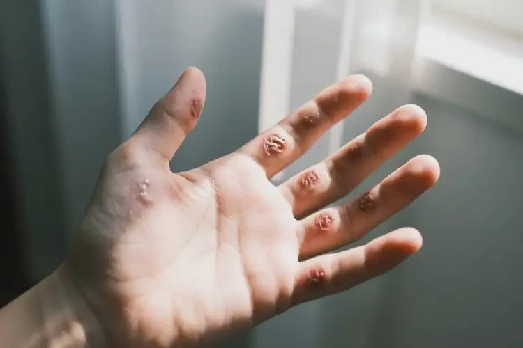 青少年手上有濕疹可不可以徹底自愈(圖1)