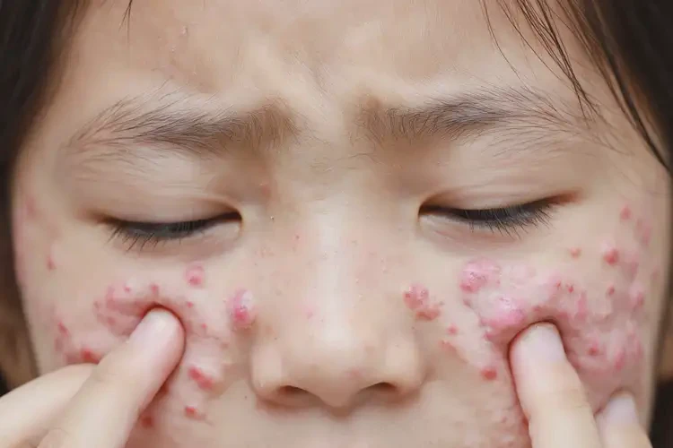 青少年身上起濕疹可以徹底自愈嗎(圖4)