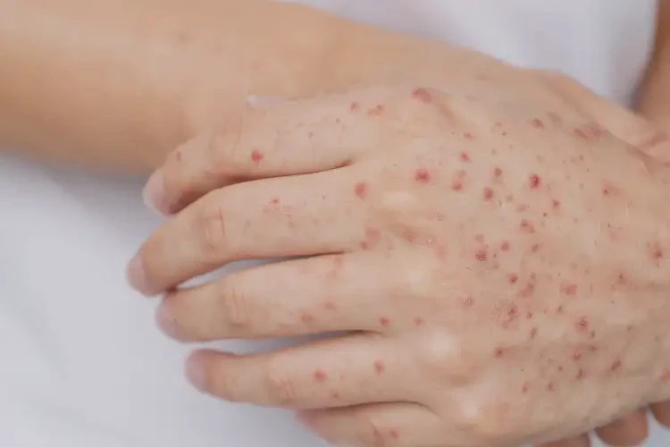 女人手上出現(xiàn)濕疹不管它會(huì)自己自愈嗎(圖4)