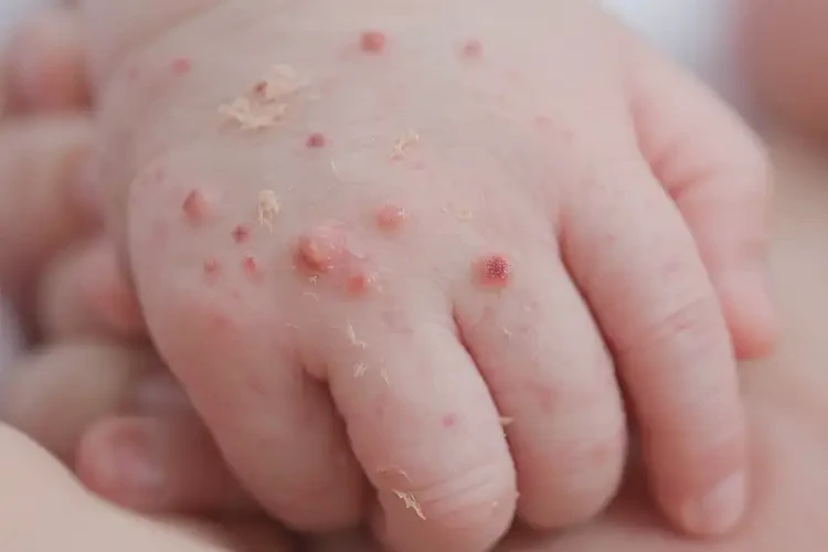 新生兒手上出濕疹能夠徹底治愈嗎(圖4)