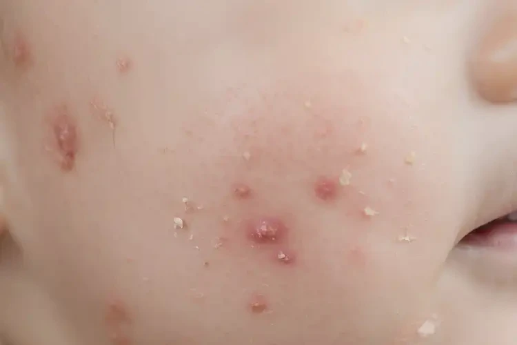 嬰幼兒臉上容易長濕疹不管它會自己自愈嗎(圖4)