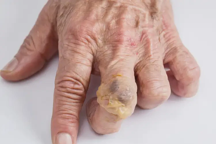 老年人手上偶爾長濕疹不管它會自己痊愈嗎(圖3)