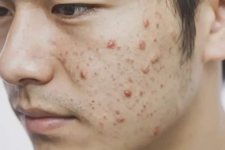 青年人臉上偶爾長濕疹能不能徹底自愈(圖4)