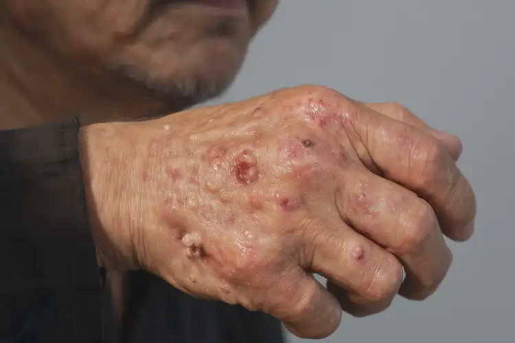 男性手上出現(xiàn)濕疹不管它會(huì)自己痊愈嗎(圖4)