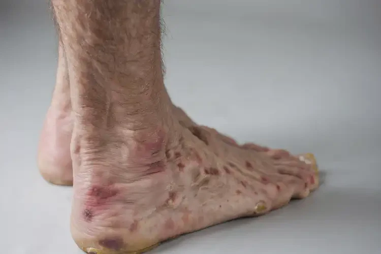 老人腳上容易起濕疹不管它會(huì)自己好嗎(圖4)