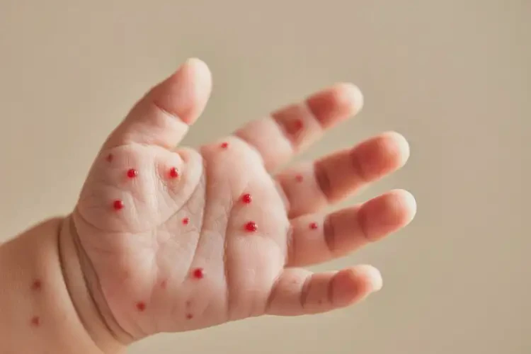 新生兒手上出濕疹可以徹底自愈嗎(圖2)