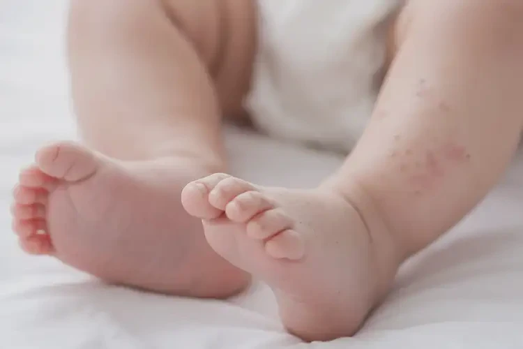 嬰兒腳上偶爾起濕疹可不可以徹底自愈(圖4)